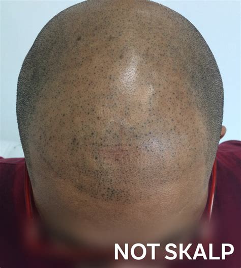 scalp micropigmentation bad results.